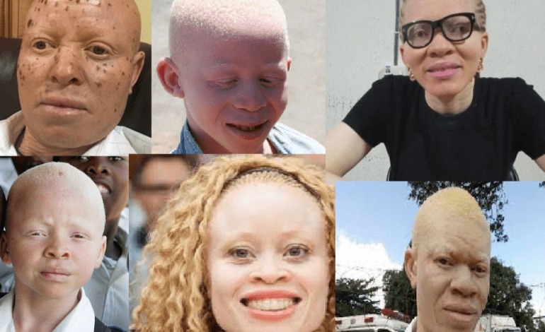 We Are Tired Of Stigmatisation, Osun Albinos Lament