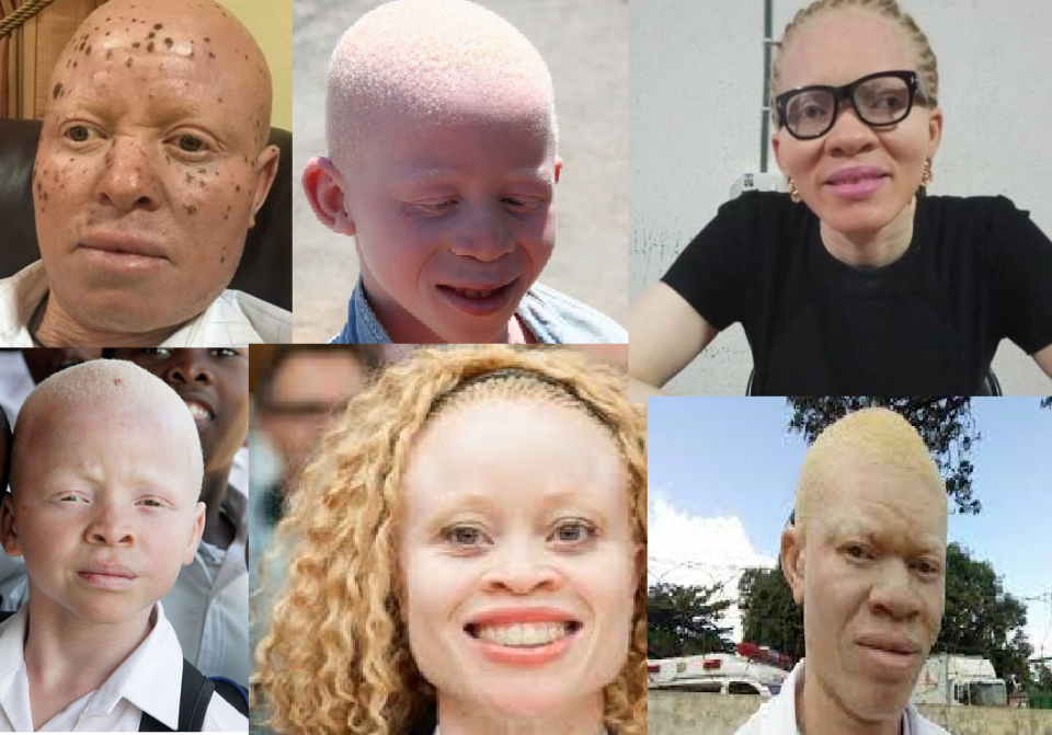 We Are Tired Of Stigmatisation, Osun Albinos Lament