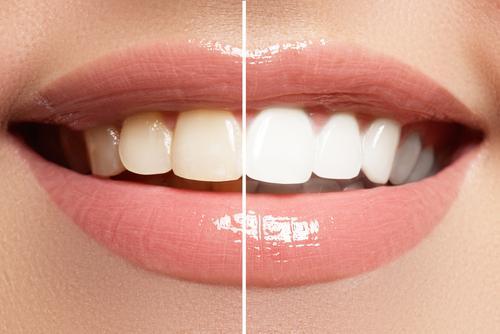 Natural Ways To Make The Teeth White
