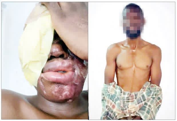 Man Who Got N500,000 To Attack Spa Owner With Acid, Mistakenly Injures Wrong Person